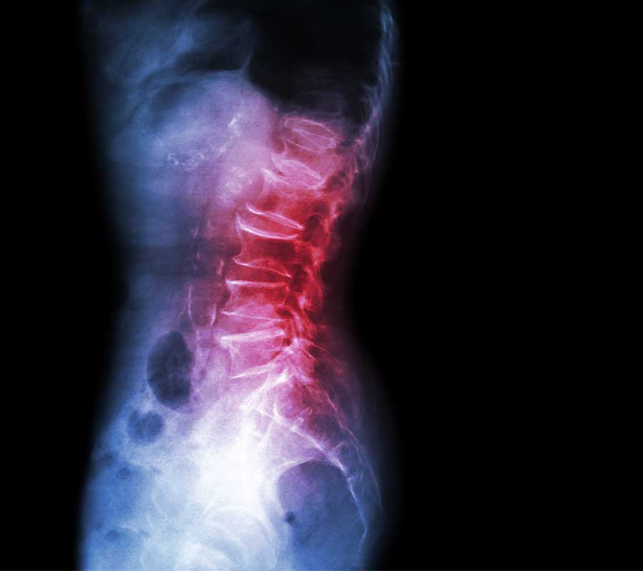 Spondiloliz ve Spondilolistezis